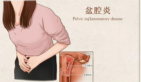 盆腔炎的症状表现、治疗方法与护理要点