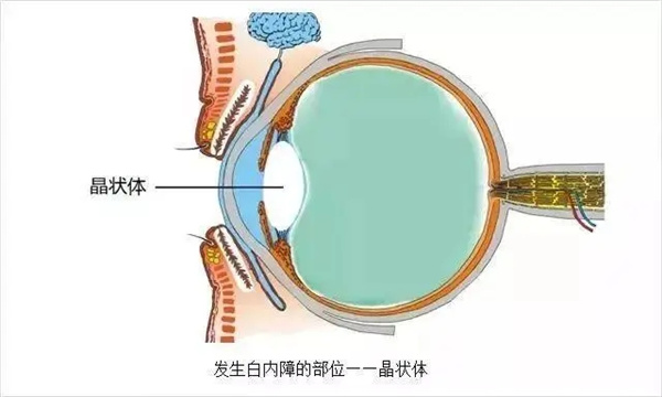 白内障的症状有哪些